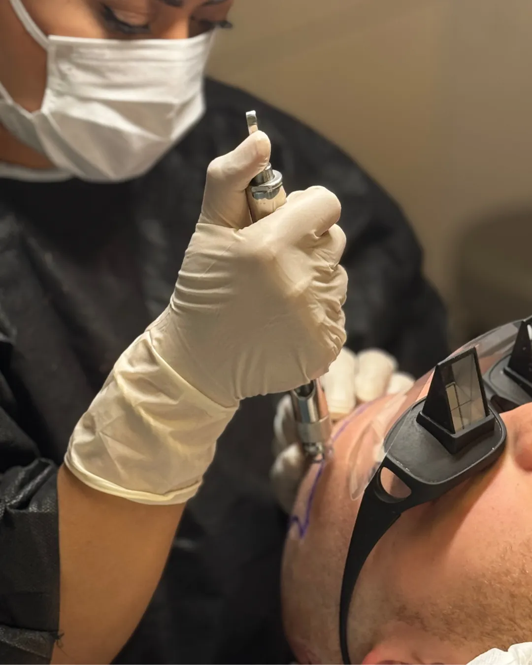 HM Hair Transplant specialist at work