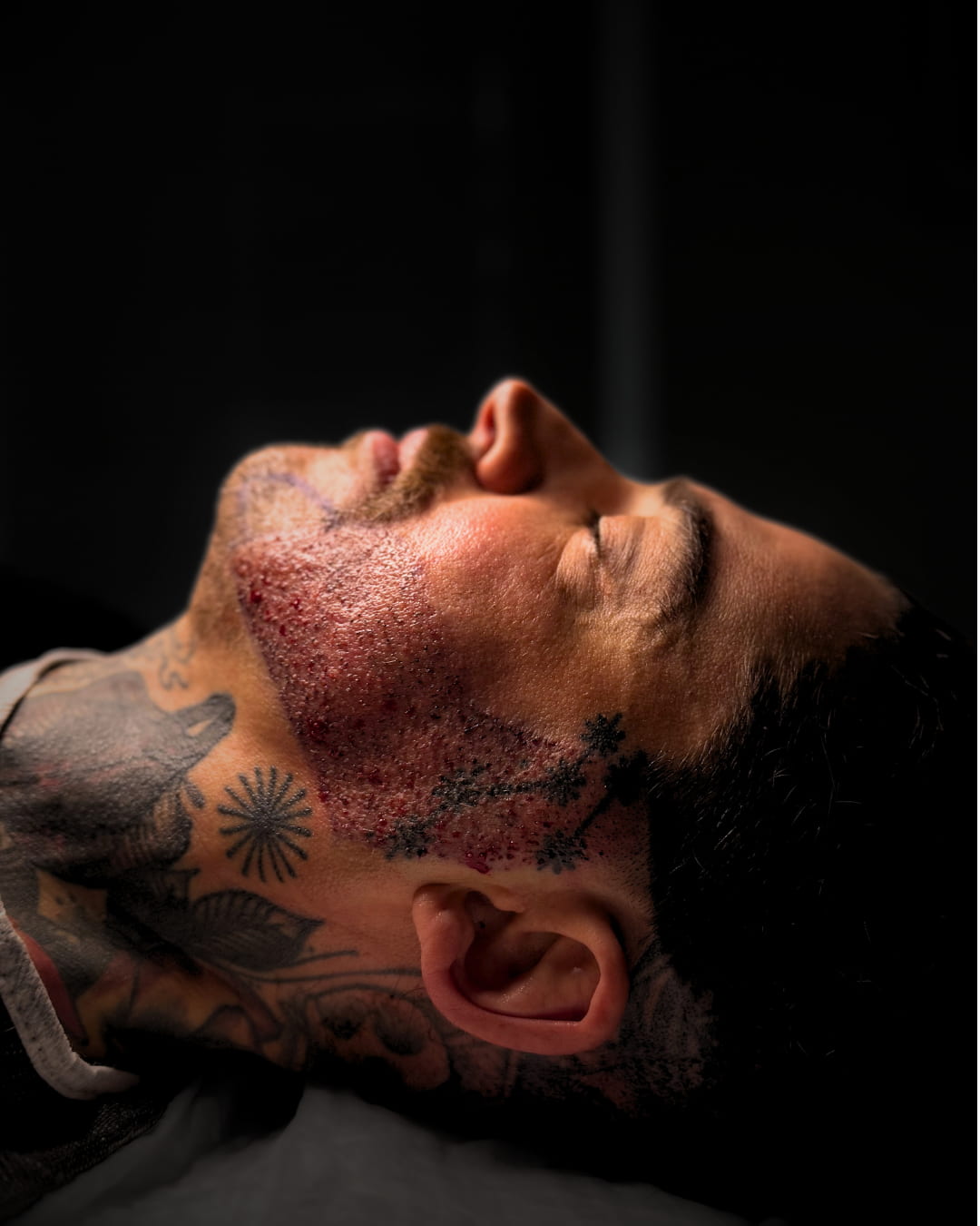 Close-up of a man's jawline after a beard transplant at HM Hair Transplantation