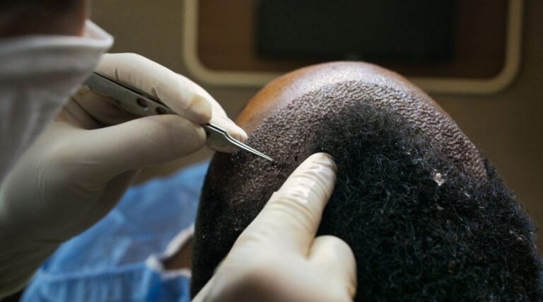 Sapphire-haartransplantatie begrijpen: De nieuwste technologie in haarherstel