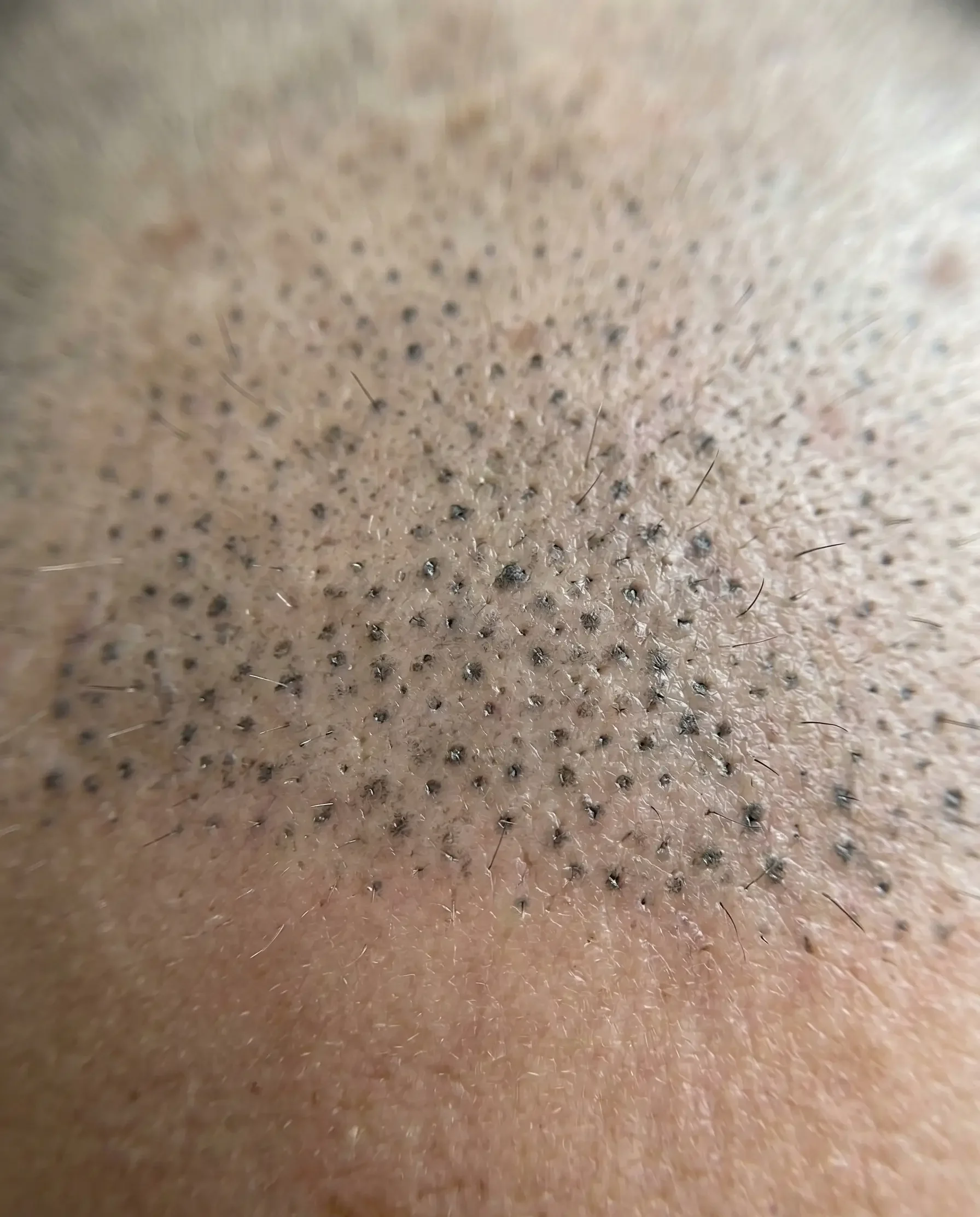 Close-up of scalp micropigmentation treatment at HM Hair Transplant, pigment dots visible on scalp