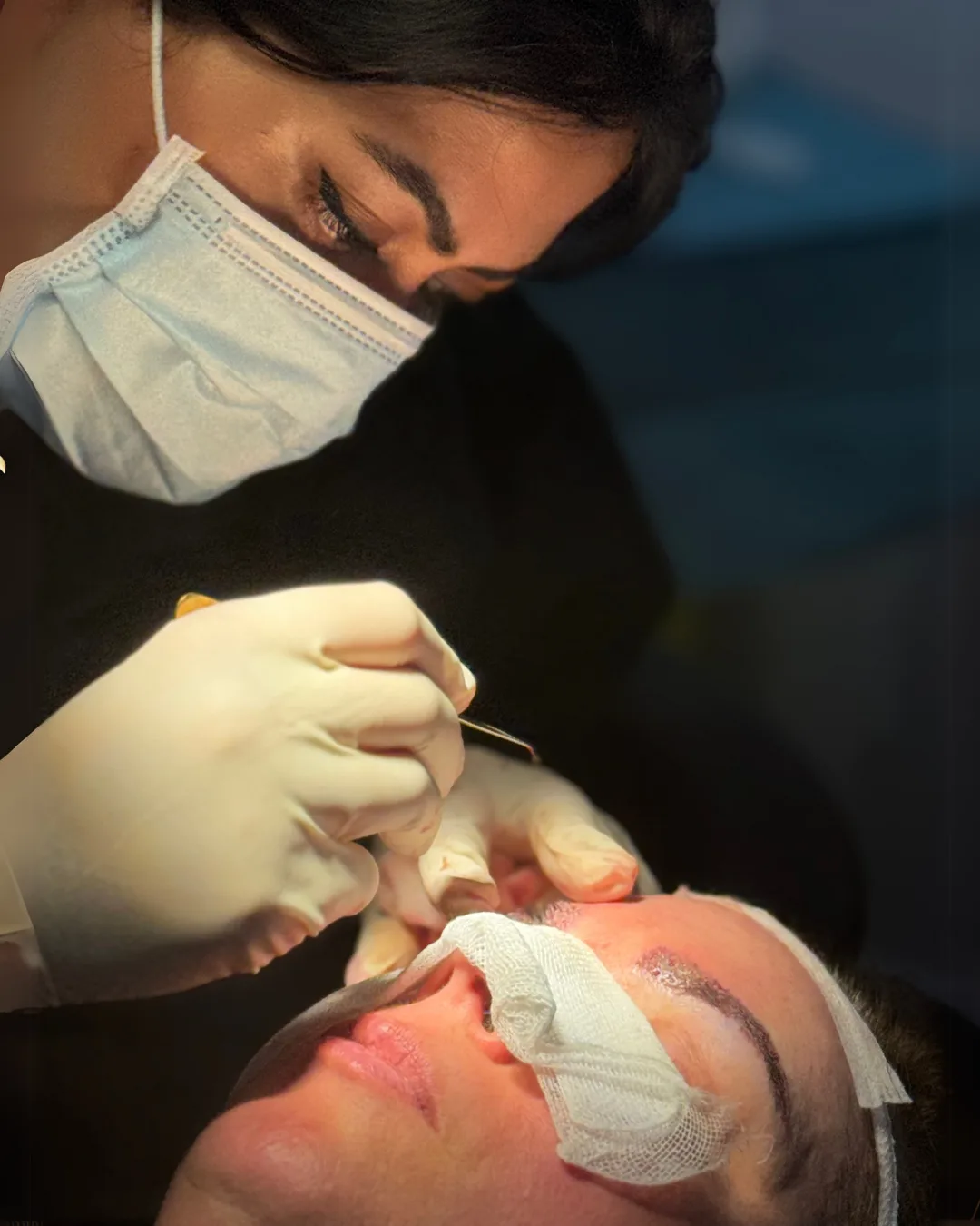 Eyebrow transplant at HM Hair Transplantation